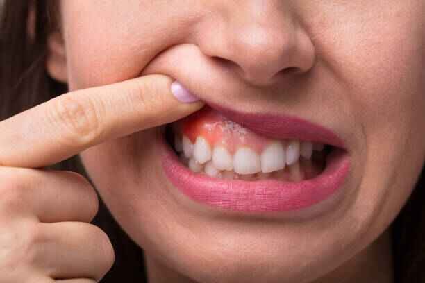 Inflamed gums showing signs of gum disease – best gum treatment in Kolkata at Apollo Dental